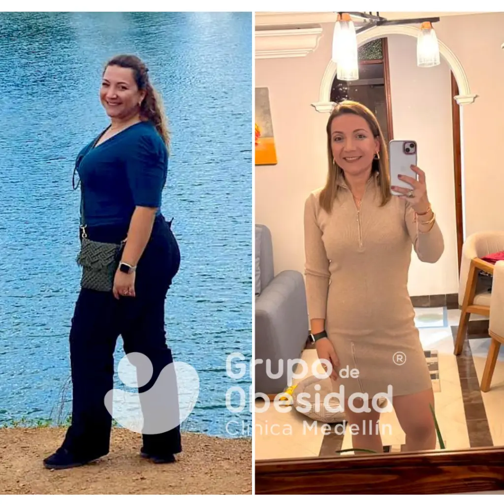 antes y despues del balón gástrico