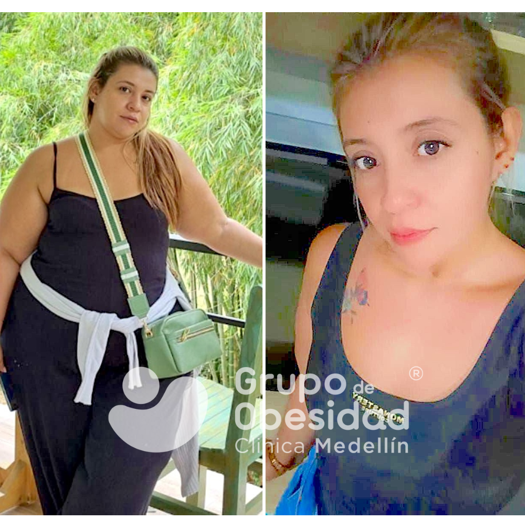 gastric balloon patient before and after