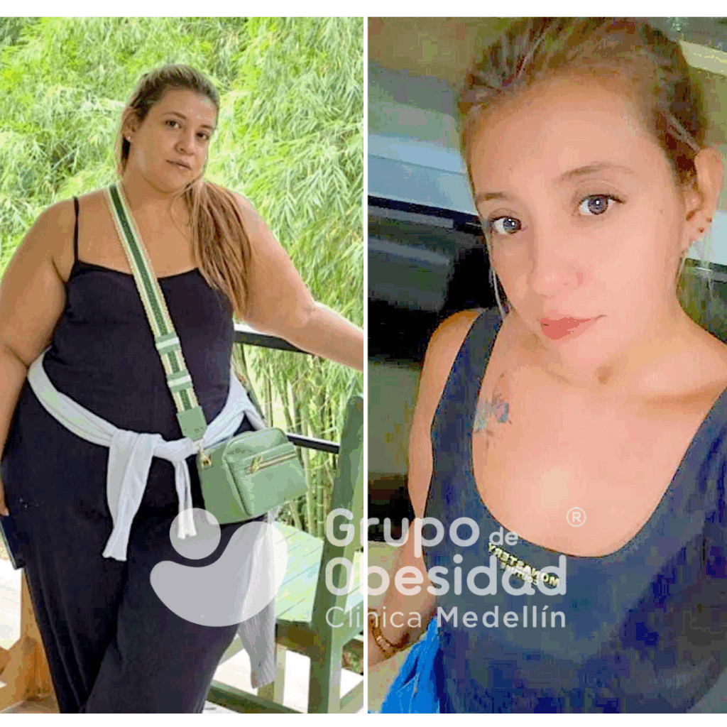 paciente balón gástrico antes y después