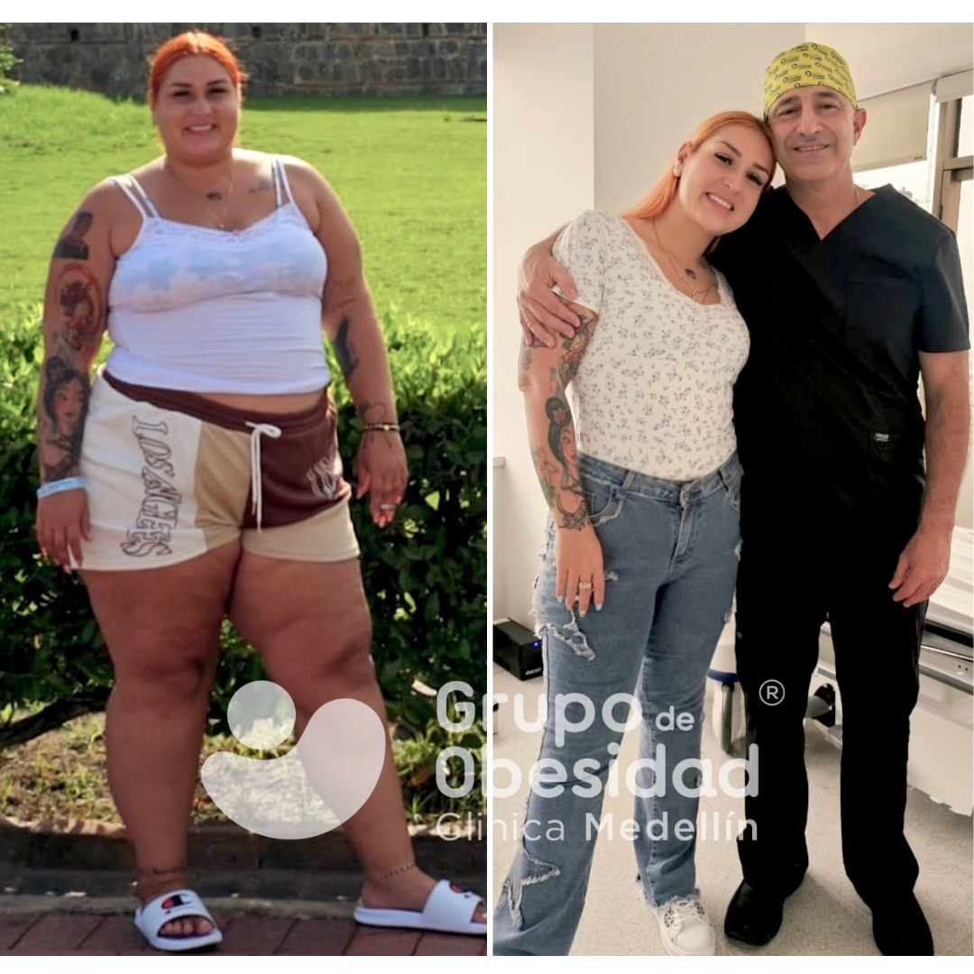 antes y despues balon gastrico